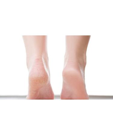 Ever Ready Hard Skin Remover Stone - Effective Foot Callus Remover - Buy Online on GoSupps.com
