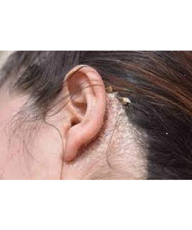 2% Pyrithione Zinc Medicated Skin Cleansing Soap Bar - 4oz | Ideal for Acne & Skin Irritation | Shop Now for International Shipping - Buy Online on GoSupps.com