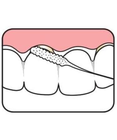 Tepe Bridge & Implant Floss - Premium Oral Care for Bridges and Implants - Buy Online on GoSupps.com