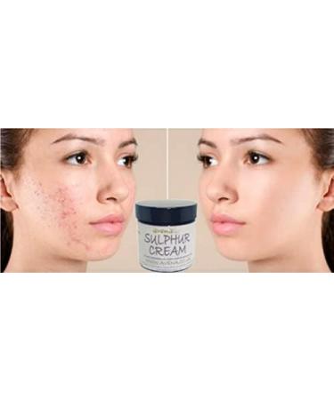 Wellmadefairtrade Herbalshire Sulphur Cream Natural Sulphur Ointment Cream Sulphur Acne Sulphur Body Cream 35g - Buy Online on GoSupps.com