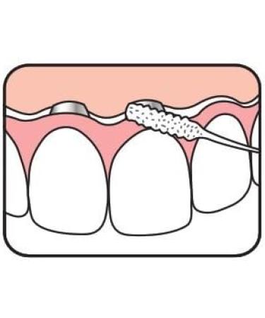 Tepe Bridge & Implant Floss - Premium Oral Care for Bridges and Implants - Buy Online on GoSupps.com