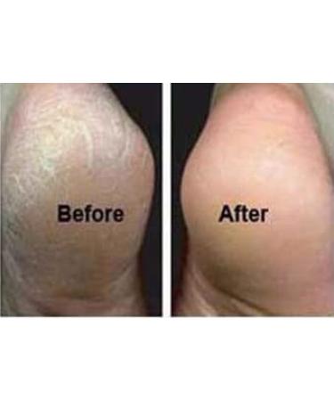 Careforyou Foot Riper - 2-Sided Metal Pedicure Tool for Safe Removal of Dead Skin & Calluses - Buy Online on GoSupps.com