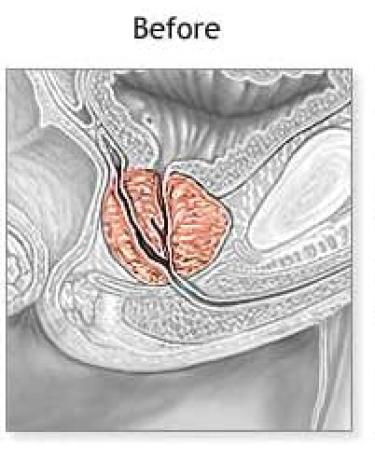 Pulean Formula - Natural Enlarged Prostate Support Winner of 5 Awards. 240 Tablets - Buy Online on GoSupps.com