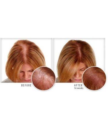 PROPIDEX Premium Hair Regrowth Treatment for Men & Women | Biotin & Saw Palmetto Formula to Prevent Hair Loss & Stimulate Follicles - Buy Online on GoSupps.com