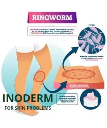 Inoderm Unguento - Effective Treatment for Acne, Pimples, Eczema, and Ringworm - Buy Online on GoSupps.com