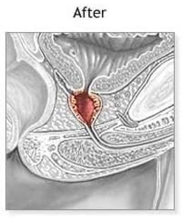 Pulean Formula - Natural Enlarged Prostate Support Winner of 5 Awards. 240 Tablets - Buy Online on GoSupps.com