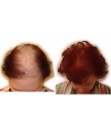 Finally Hair Fiber Lock Strong Hold Spray - Compatible with Toppik, Xfusion, Febron, Bosley, Nanogen - Buy Online on GoSupps.com