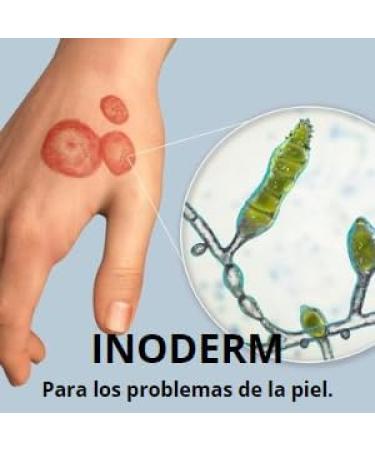 Buy 1 oz. Ointment for Pimples Eczema Ringworm & Acne - Fast Shipping Worldwide - Buy Online on GoSupps.com