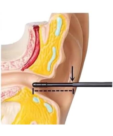 Effective Earwax Removal Kit - 20 Pcs Ear Dippers & Sticky Ear Pickers - International Shipping Available - Buy Online on GoSupps.com