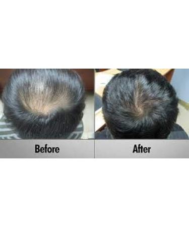 PROPIDEX Premium Hair Regrowth Treatment for Men & Women | Biotin & Saw Palmetto Formula to Prevent Hair Loss & Stimulate Follicles - Buy Online on GoSupps.com