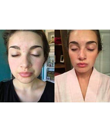 Gentle Natural Acne Cleanser with Tea Tree Oil & Aloe Vera for Clear Skin - Keeva Organics - For Teens and Adults - Buy Online on GoSupps.com