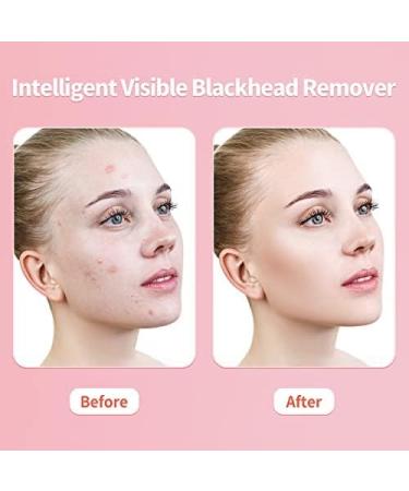 20x Magnification Blackhead Remover Tool with Camera & Light - Rechargeable Extractor for iPhone, iPad & Android - Buy Online on GoSupps.com