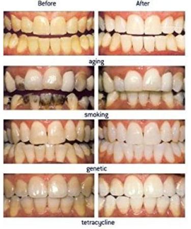 1 Teeth Whitening 3ml 44% Syringe with "Gummy" Tray NiceWhites Whiten at Home Kit. - Buy Online on GoSupps.com