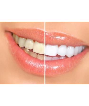 Professional 44% Carbamide Peroxide Teeth Whitening Kit with Gel, Trays, and LED Light - Buy Online on GoSupps.com