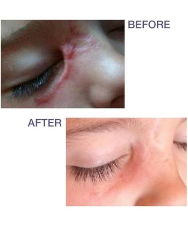 Pro-SIL Silicone Scar Treatment Stick 4.25g - FDA Cleared & Clinically Proven - Made in USA - Buy Online on GoSupps.com