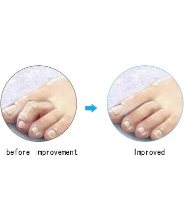 Deaver Toe Clip Hole Splitter & Silicone Separator | Soft Gel Protectors & Spacers - 3 Pairs for Comfortable Foot Care - Buy Online on GoSupps.com