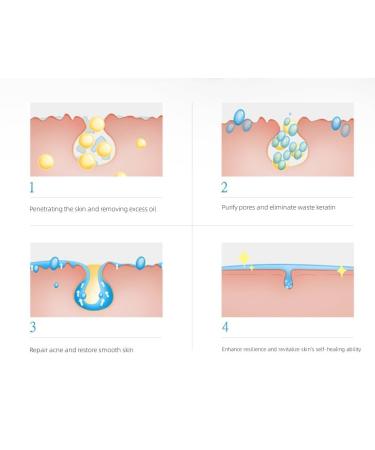 Buy Acne Removing Gel Online | Fast International Shipping & Best Results - Buy Online on GoSupps.com