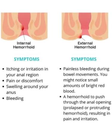 EXQST Heca Herbal Hemorrhoid Capsules - Quick Natural Relief from Pain & Discomfort - Buy Online on GoSupps.com