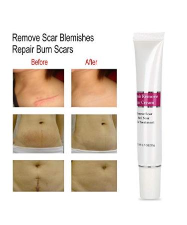 Scar Removal Cream | Anti-Scar Gel for Old Scars, Stretch Marks & Burned Skin Repair - Buy Online on GoSupps.com