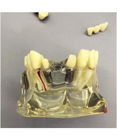 Fhuili Teeth Implant Model - Removable Chewing Gum & Prosthesis - Half-Port Bridge Restoration for Study & Recovery - Buy Online on GoSupps.com