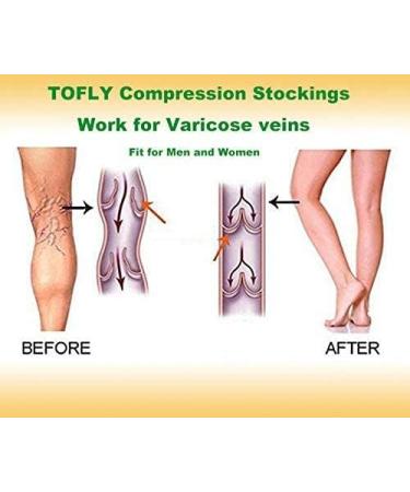 TOFLY Medical Compression Stockings XL | 20-30 mmHg Knee High Socks | 15-20mmHg Open Toe Beige | Shop Now - Buy Online on GoSupps.com