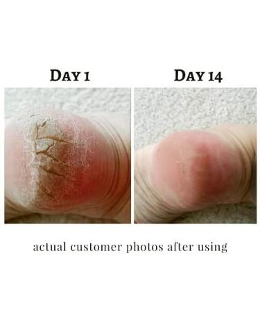 Foot Repair Serum Treatment for Dry, Cracked Heels, Eczema & Rough Feet - Moisturizing Lotion for Calluses - Dead Skin Remover - Anti-Drying Formula - Buy Online on GoSupps.com