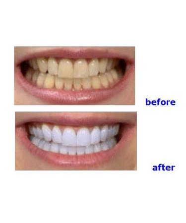 NSKI LED Teeth Whitening Light Accelerator Lamp 6000mw/c YS-TW-A - US Stock by East Dental - Buy Online on GoSupps.com