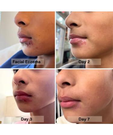 Blossom Essentials Honey Salve - Nut Free - Organic Manuka Honey Hydration Repair - Eczema Relief for Dry Itchy Sensitive Skin - Soothing Moisturizer & Balm for Kids Adults - Made in USA - 4oz - Buy Online on GoSupps.com