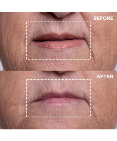 Wrinkles Schminkles Eye & Mouth Lift Set | Reusable Silicone Patches for Mouth & Lip Wrinkles (2-Pack) & Eye Wrinkles (3-Pairs) - Shop Internationally - Buy Online on GoSupps.com