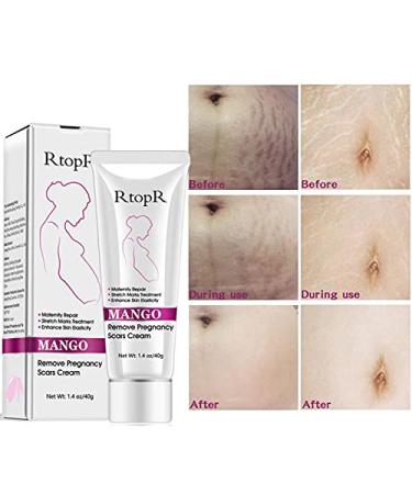 Mango Stretch Marks & Scar Cream (40g) | Pregnancy & Obesity Scar Removal - Wrinkle Reduction & Moisturizing - Buy Online on GoSupps.com