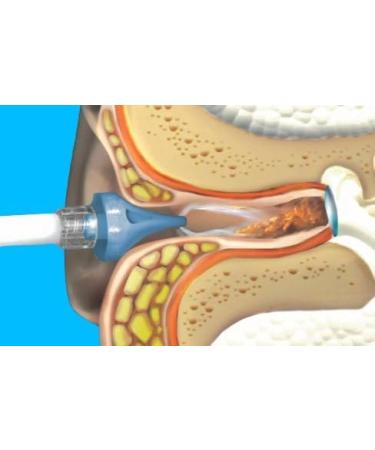 Tridal Wave Ear Washer System - Home Solution for Safely Removing Built-Up Earwax and Preventing Future Buildup (with Ear Basin) - Buy Online on GoSupps.com
