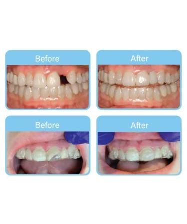 OrVance Aligner Pontics | 32 Count Clear Aligner Tray Fillers for Missing Teeth - Buy Online on GoSupps.com