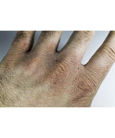 Natural Cream For Skin Healing Burns Sunstrokes Insect Bites Eczema - Buy Online on GoSupps.com