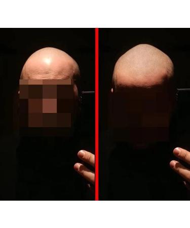 Zero Shine 2.0 Scalp Aftercare - Moisturizing & Mattifying for Bald Scalps & SMP | Best International Shipping - Buy Online on GoSupps.com