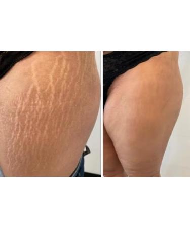  G n rique Super Effective Stretch Mark Peel Black Soap 100g - Buy Online on GoSupps.com