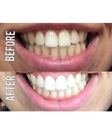 Smile Sciences Teeth Whitening Ultra Red & Blue LED Light - Effective International Shipping Available - Buy Online on GoSupps.com