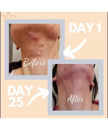 Anirva ClearDerm: Zinc Skin Supplement for Hormonal Acne & Rosacea - Adult Acne Zinc Pills - Buy Online on GoSupps.com