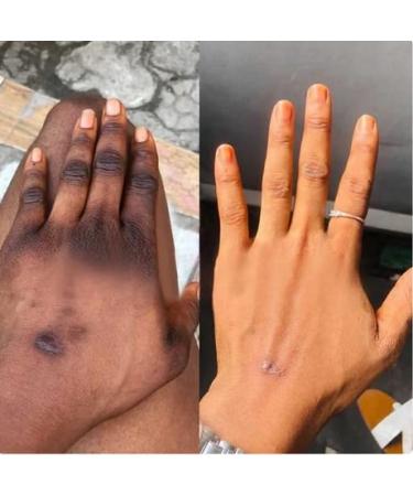 Nigrifree Acanthosis Nigricans Therapy Cream - Dark Spot Corrector with Lactic Acid & Retinol - Treatment for Dark Elbows, Knees, Underarms, Bikini Area & Neck - Buy Online on GoSupps.com