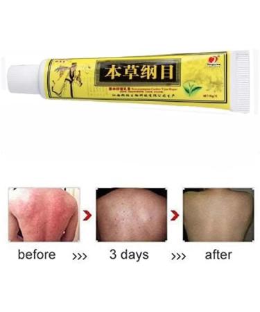 Omaky Chinese Herbal Eczema Psoriasis Creams - Dermatitis & Pruritus Ointment (2pcs) | New Packaging - Buy Online on GoSupps.com