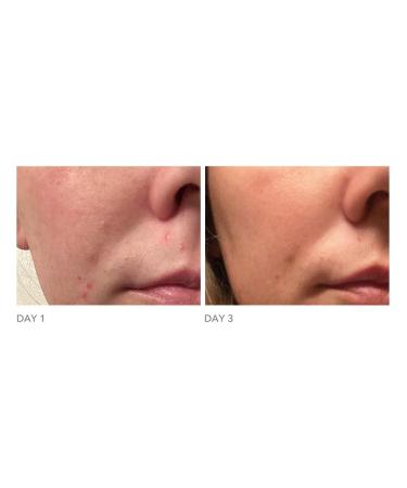 Dr Dennis Gross DRx Blemish Solutions Acne Eliminating Gel - 1.0 fl oz - Buy Online on GoSupps.com