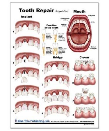 Tooth Anatomy & Implant Repair Support Card Set - Enhance Dental Knowledge | International Shipping Available - Buy Online on GoSupps.com