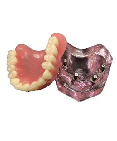 Vinbcorw Dental Modell -Maxilla Mini 4 Implant screws -Mobile prosthesis Repair of medical patient communication removable pink pink