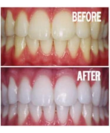 Professional 44% Carbamide Peroxide Teeth Whitening Kit with Gel, Trays, and LED Light - Buy Online on GoSupps.com