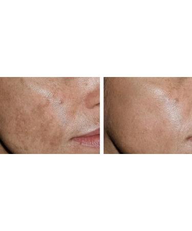 Effective Skin Care Solutions: Cure Acne Psoriasis Sunspots & Scars Shop Internationally - Buy Online on GoSupps.com