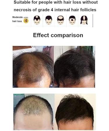 Capuchon th rapie au laser pour repousse cheveux casque Laser Anti-chute de cheveux - Buy Online on GoSupps.com