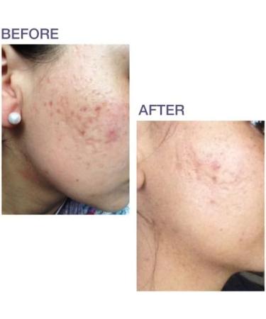 Pro-SIL Silicone Scar Treatment Stick 4.25g - FDA Cleared & Clinically Proven - Made in USA - Buy Online on GoSupps.com