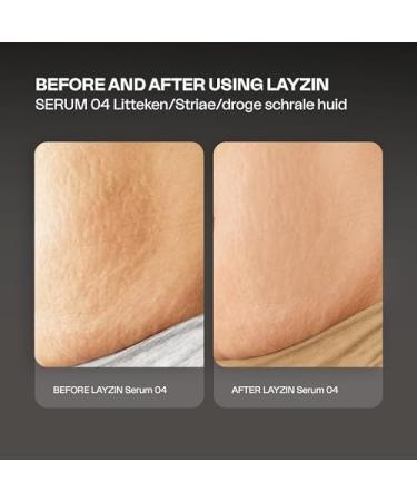  Layzin Scars & Striae Products (Serum 04) - Buy Online on GoSupps.com