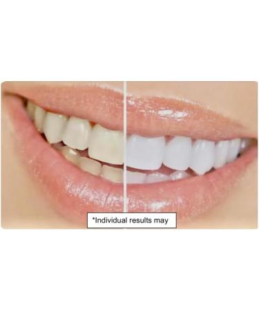 Buy Barkate Nehi Whitening Pens - 35% Carbamide Peroxide Gel 3 Pack Whitening Treatment for Bright Smile - International Shipping Available - Buy Online on GoSupps.com