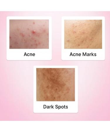 Iguana 2% Kojic Acid + 1% Alpha Arbutin Brightening Facial Serum | Dark Spot Corrector & Skin Tone Evenner Skin Glow Booster 30 ml (1 fl oz) - Buy Online on GoSupps.com