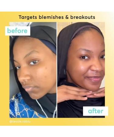 Super Facialist On The Spot Clarifying Gel - Spot Treatment for Acne with 10% Niacinamide Tea Tree Oil & Prebiotics Vegan Friendly 15ml - Buy Online on GoSupps.com